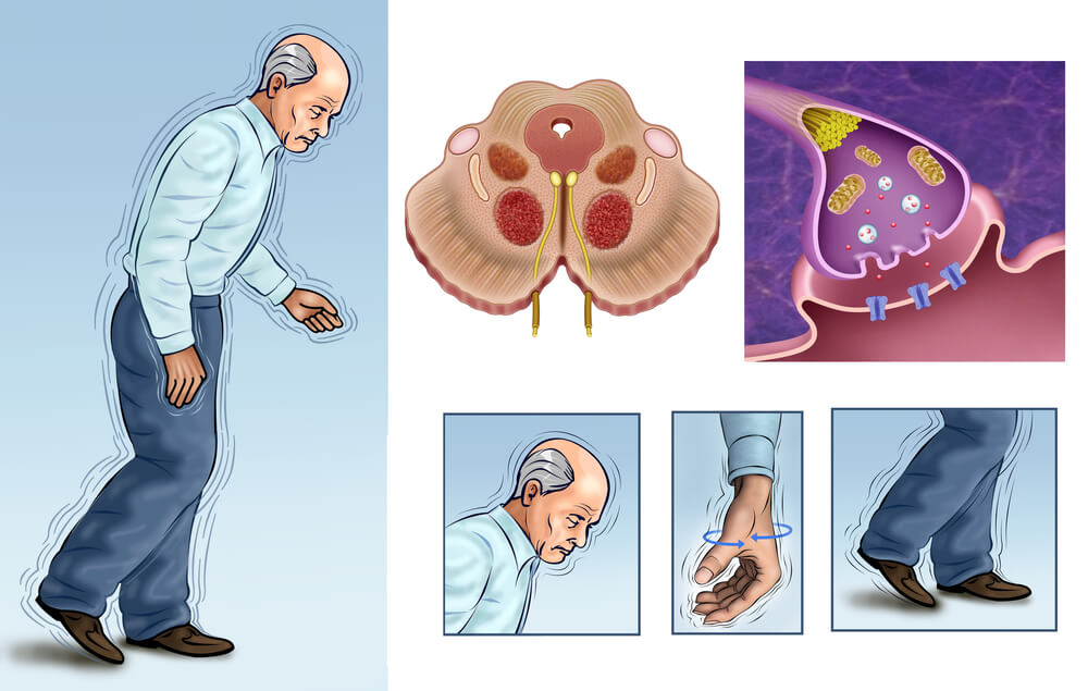 choroba-parkinsona.jpg